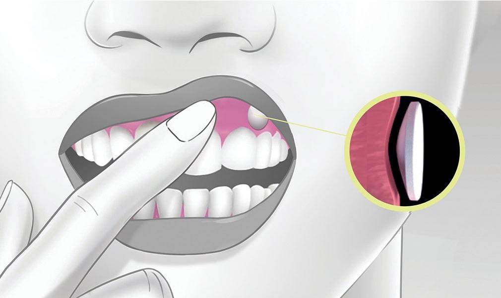 Illustration du comprimé buccogingival muco-adhésif à placer sur la gencive