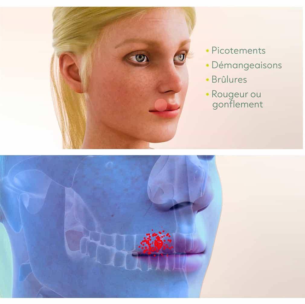 Focsur sur l'infection - Herpes labial : picotements, démangeaisons, brûlures, rougeur ou gonflement