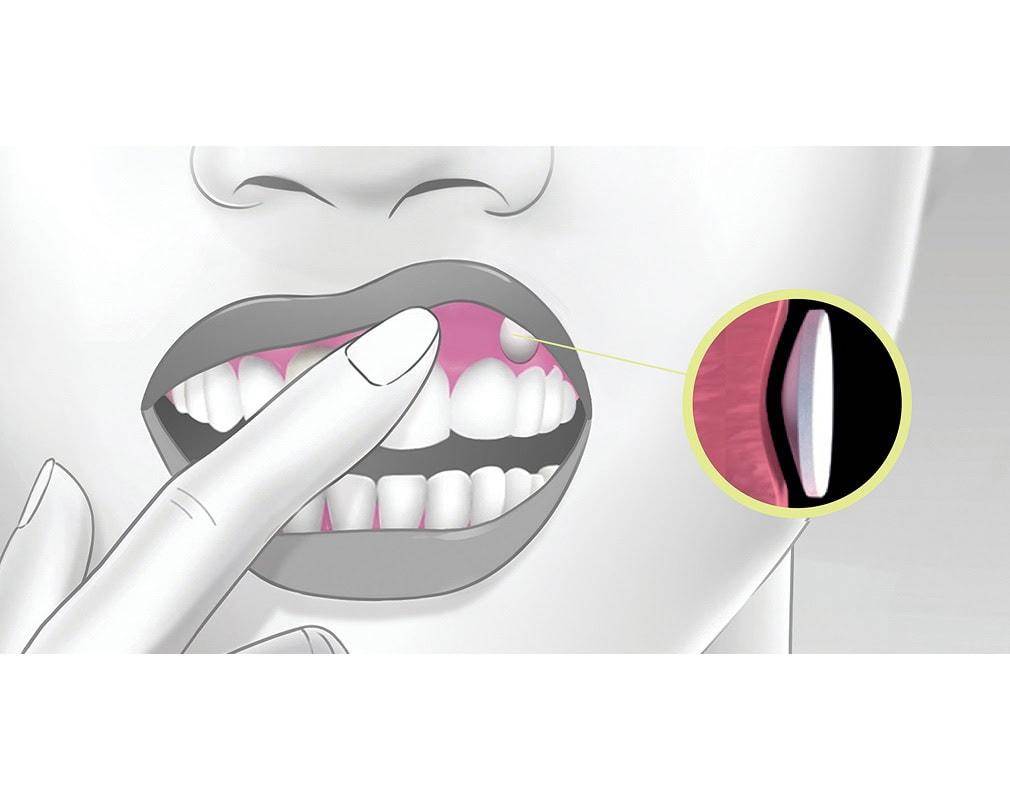 Virpax : application sur la gencive